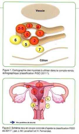 Hysteroscopie, Le Fibrome | Hysteroscopie diagnostique Paris