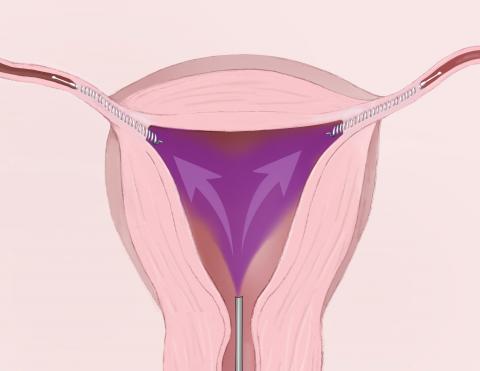 La Stérilisation par hystéroscopie: la technique Essure©