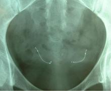 présence des micro implants sur  une radio de l'abdomen 3 mois après la pose